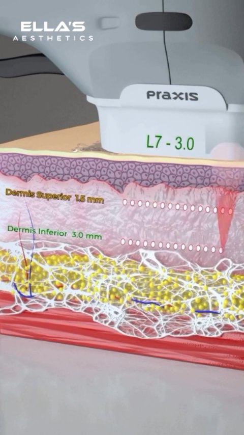 Lift, tighten, and redefine your natural contours with advanced HIFU treatment—non-surgical, safe, and effective.

#hifutreatment 
#skintightening 
#youthfulskin 
#nonsurgicallift 
#antiaging