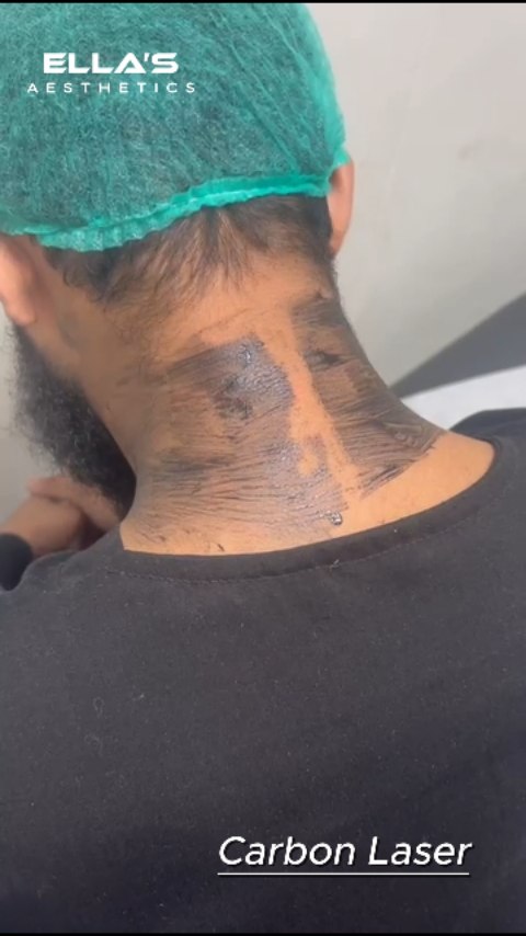 Smooth neck, flawless glow with carbon laser magic. ✨

#ellasaesthetics #neckcarbonlaser #lasertreatment #youthfulskin #radiantskin