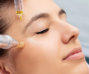 Face PRP and Micro needling